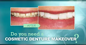 Cosmetic Denture Makeover