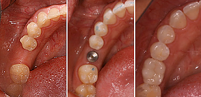 Dental Implants Installed by Dr. Kilby