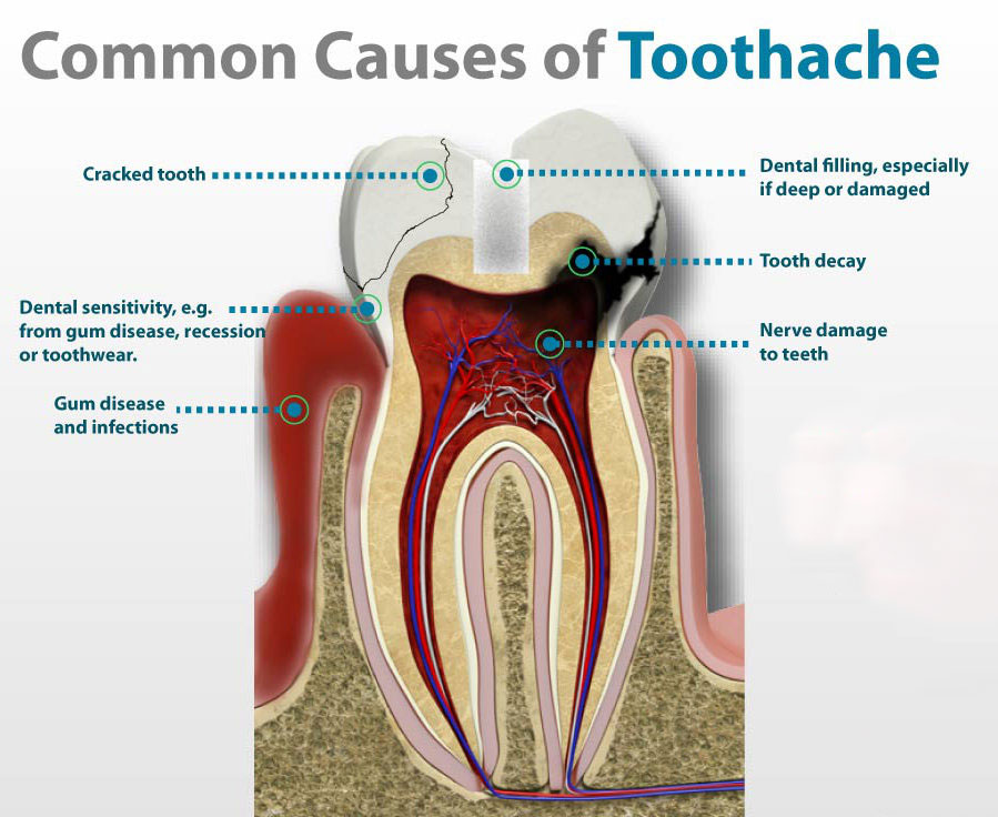 wisdom tooth filling