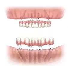 diagram of dental implants Valdosta GA