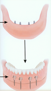 Mini_Dental_Implants