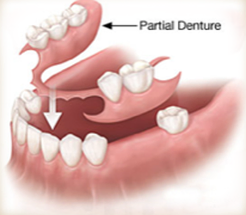 Partial Denture