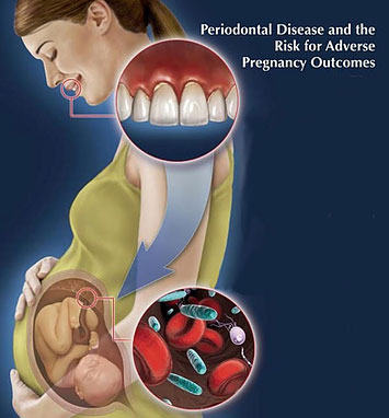 Periodontal Disease and Pregnancy Outcomes