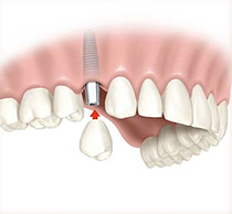 Single_Implant Valdosta GA