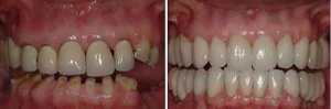 before_and_after_teeth_2