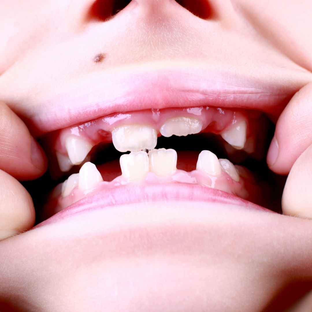 Childhood Tooth Decay: What Causes It? 