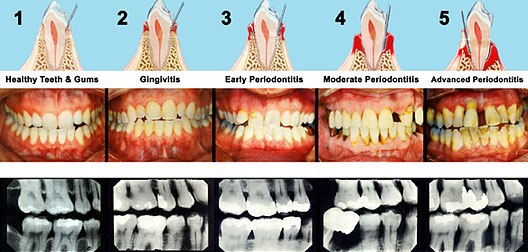 Examples of Periodontal disease