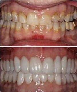 restorative dentistry Before and After