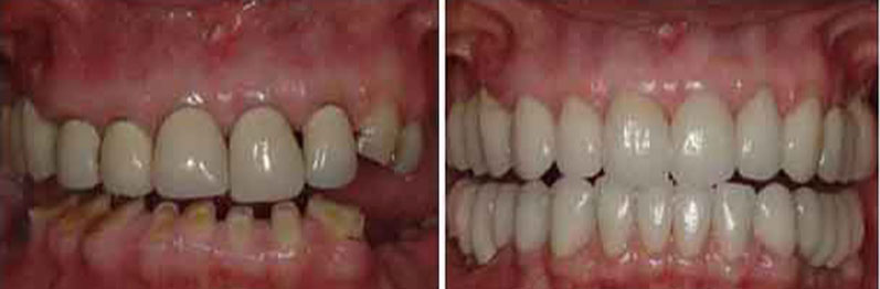 Before and After full mouth rehabilitation
