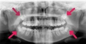 Impacted Wisdom Teeth X-Ray