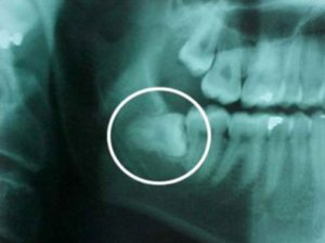 Molar Tooth X-Ray