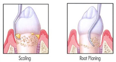 Scaling and Root Planing Examples