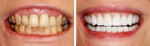 Full Mouth Reconstruction with Crowns, Bridges after Periodontal Surgery