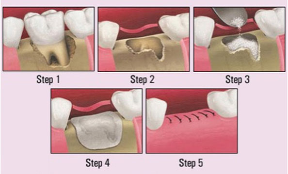 How To Sleep After Tooth Extraction And Bone Graft