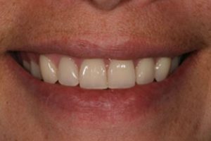 Dental implants in Valdosta