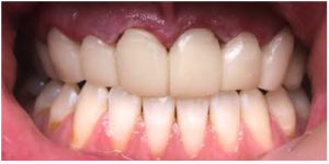 Temporary crowns of upper front teeth