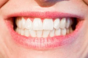 Two common dental restorations