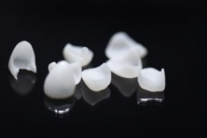 preparing for veneers