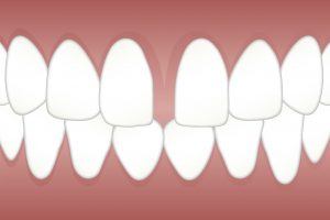 Options for filling in a gap tooth