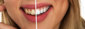 Common myths about teeth whitening