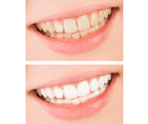 Do you want whiter teeth, but you’re not sure which way to go There are two overall options for teeth whitening, at-home versus at the dentist office.