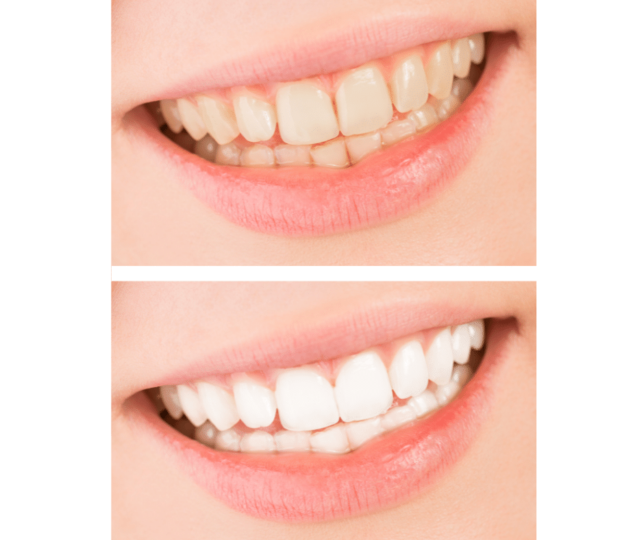 Teeth whitening Kilby Family and Cosmetic Dentistry