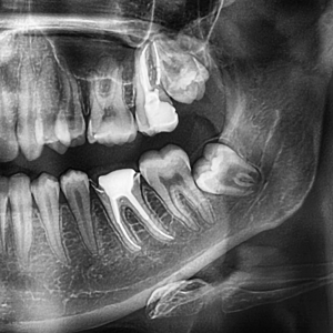 When Should Wisdom Teeth Be Removed